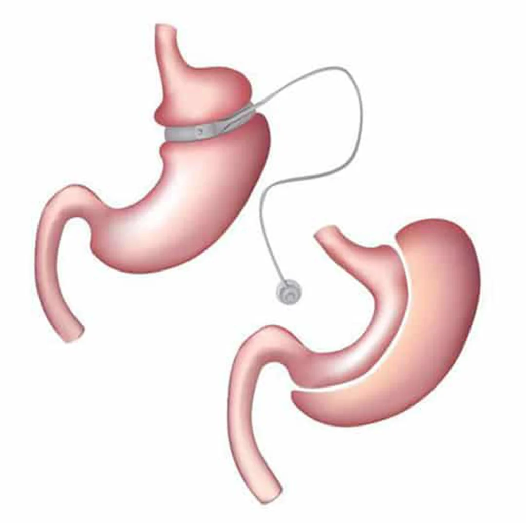 5-year outcomes of 1-stage gastric band removal and sleeve gastrectomy