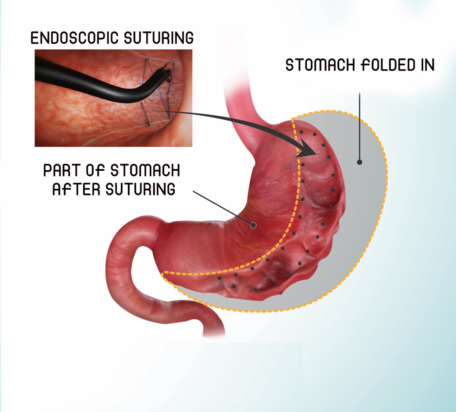 Endoscopic Sleeve Gastroplasty The official website Professor Ayedh